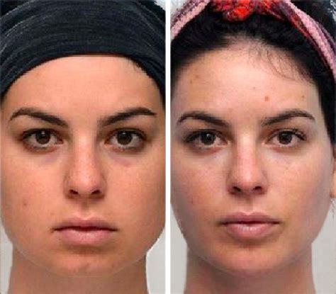 Gua Sha before/after: results and photos .